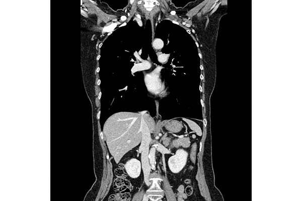 d: Coronal contrast CT image from the chest to upper abdomen