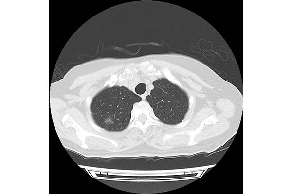 a: Chest CT with a slice thickness of 5 mm