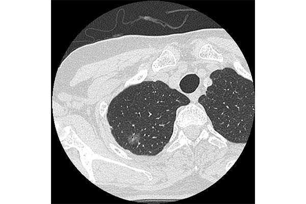 b: Thin-slice CT image