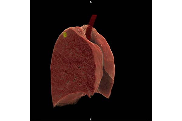 c: 3D image of the entire lung with the lesion shown in yellow