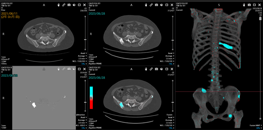 Monitor screen image of the “temporal difference display of bone regions” system“Visualization of Temporal Changes in Bone Regions” system employs fusion images generated by superimposing current and prior images to selectively visualize changes in bone over time. 
