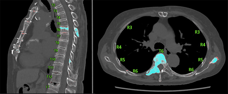 Monitor screen image of spine and rib labeling