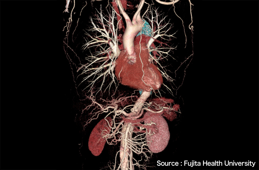 A 3D image created by the Aquilion ONE system (Peripheral blood vessels of a lung field, heart and liver)