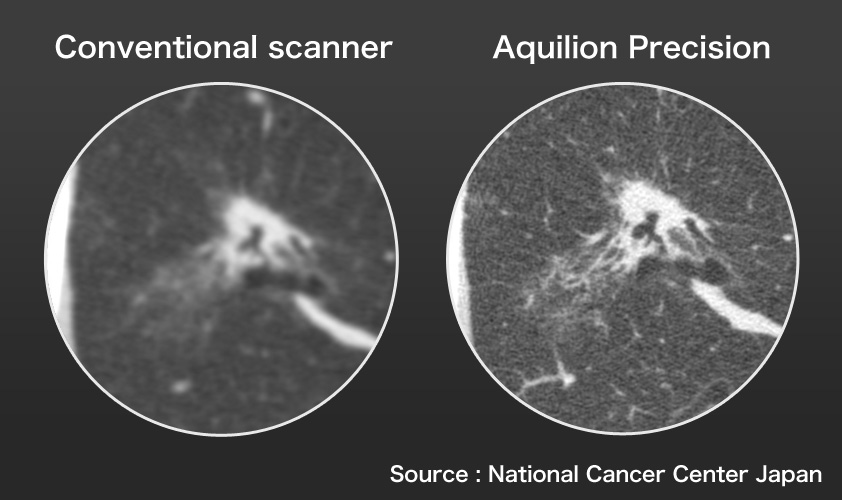 Illustration comparing Aquilion Precision and conventional product of clinical images (Pulmonary adenocarcinoma)