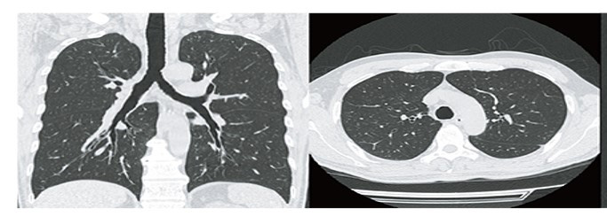 Frontal image of the lungs and axial image of the chest　obtained by CT