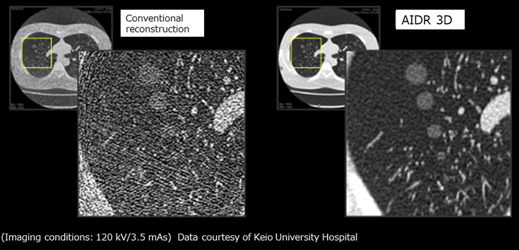 Example of a chest phantom with simulated nodules imaged with a low radiation dose (3 mAs)