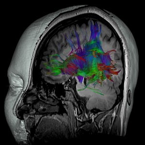 Brain MRI image