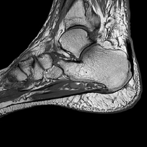 Ankle MRI image