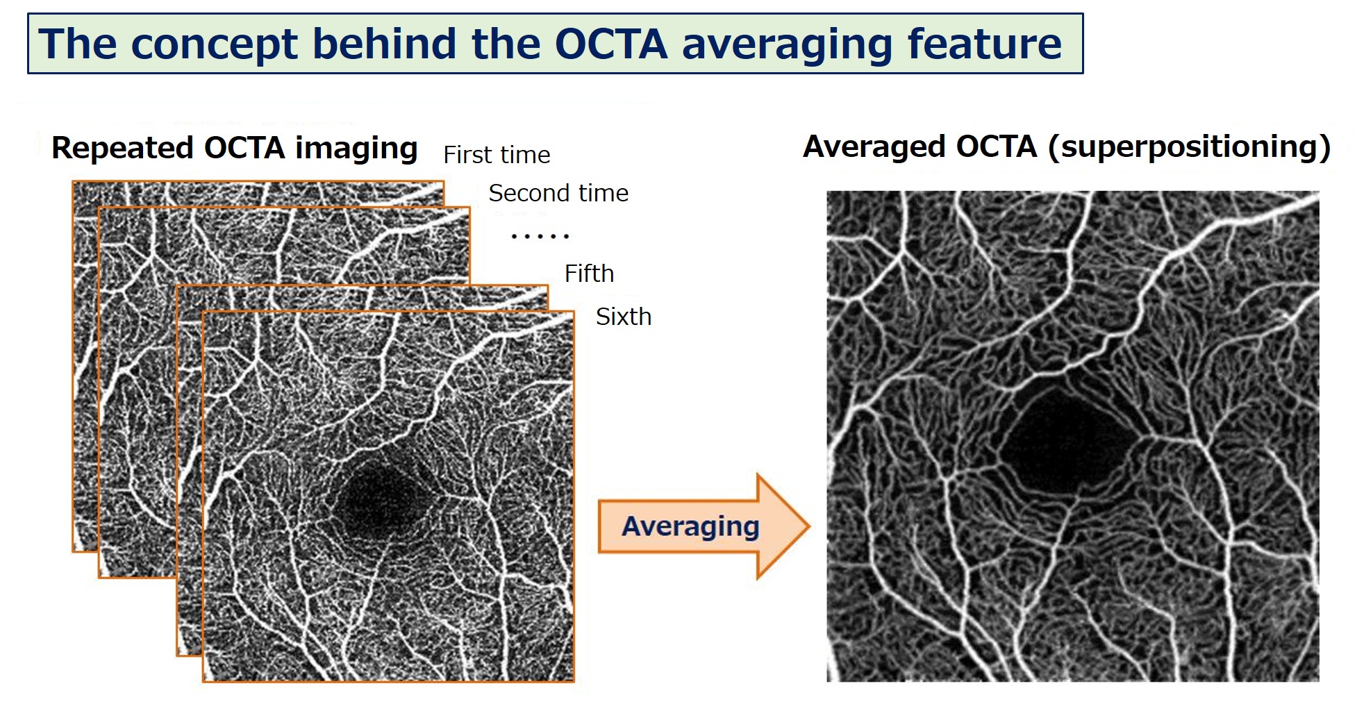 Image created by repeated OCTA scans followed by image registration and overlay processing