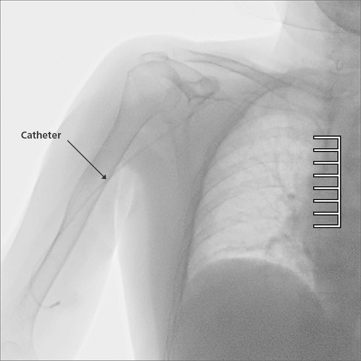 The catheter can be clearly observed even in areas where viewing is usually difficult.