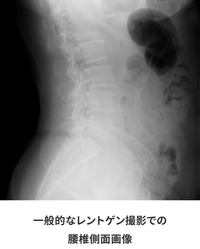 一般的なレントゲン撮影での腰椎側面画像