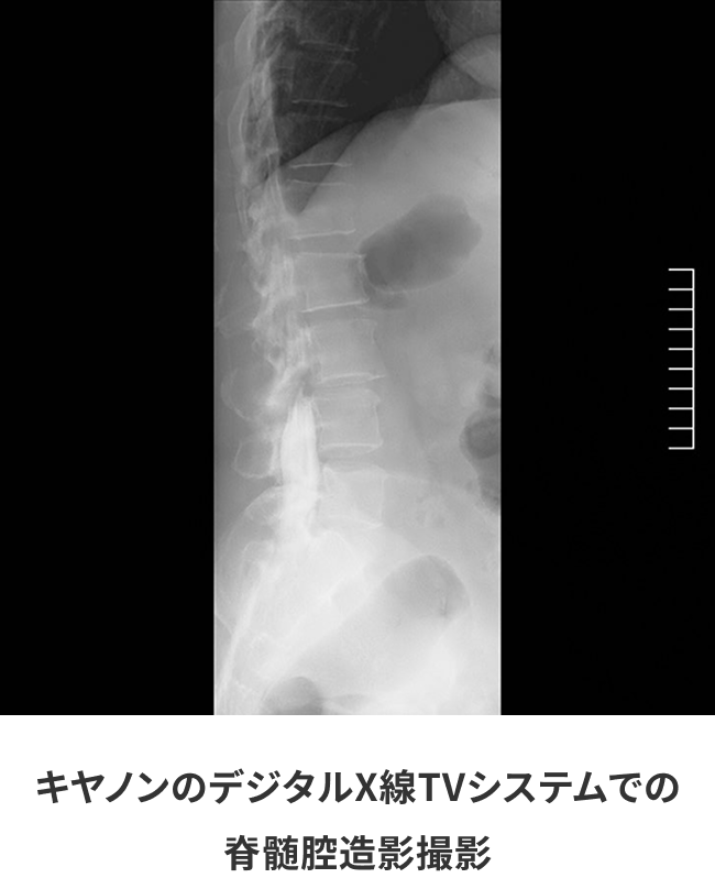 キヤノンのデジタルX線TVシステムでの脊髄腔造影撮影