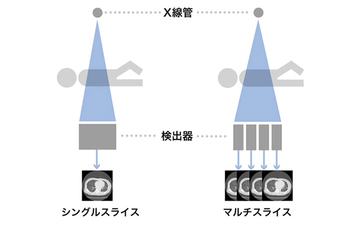 シングルスライスとマルチスライスの比較イメージ図です。