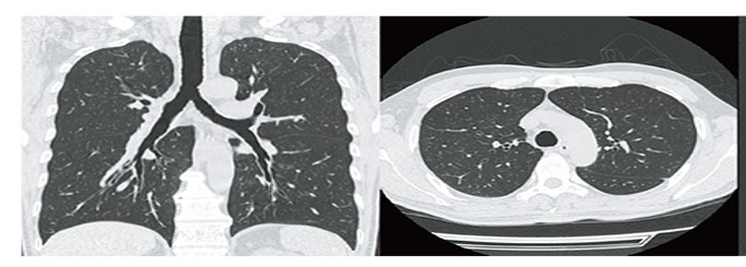 肺と胸部のCT画像