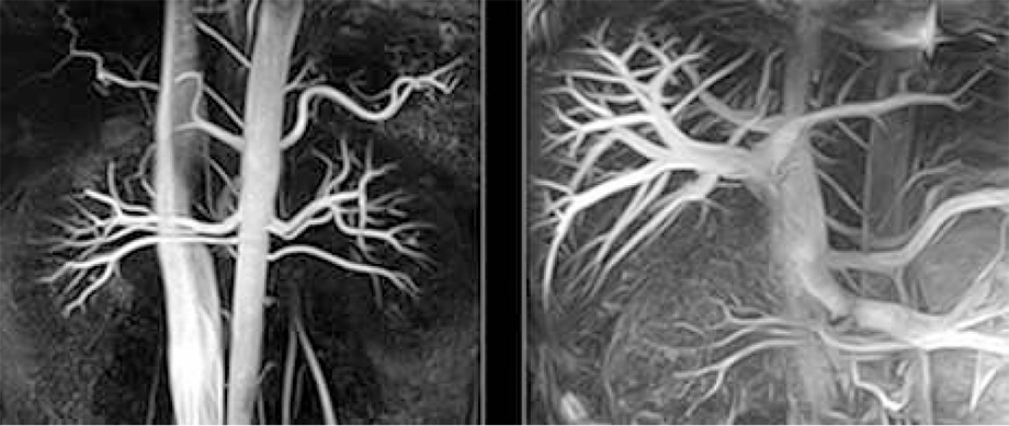 Time−SLIP法により選択的に描出された腎動脈と門脈の画像です。