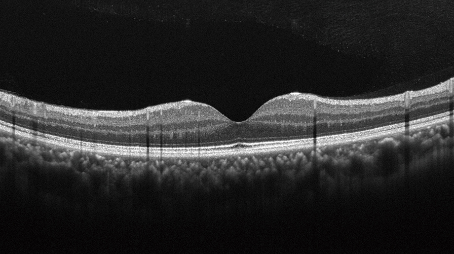 眼底のOCT画像