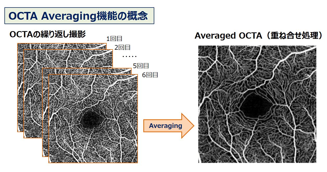 OCTAの繰り返し撮影後、重ね合わせ処理を実施した画像