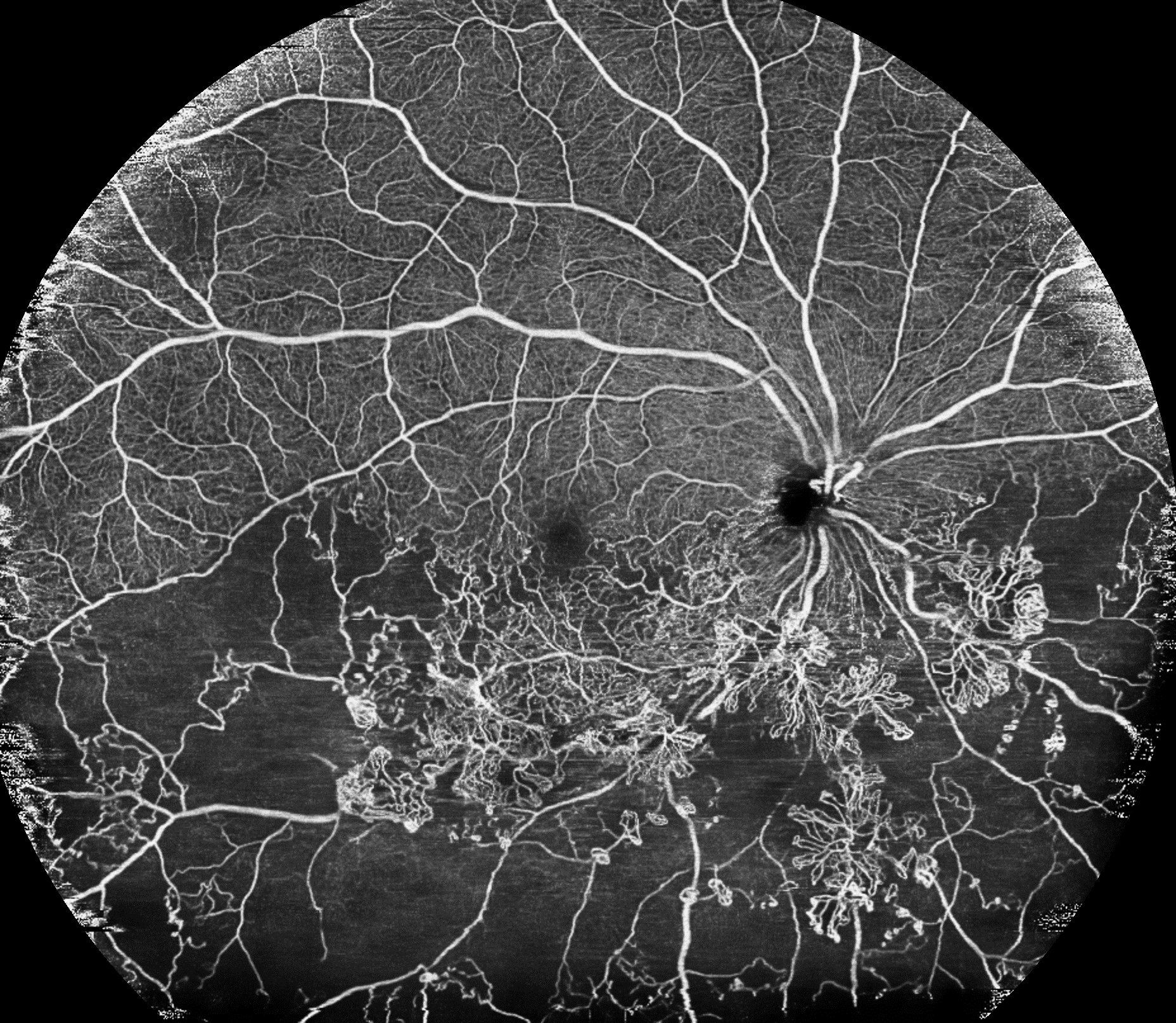 毛細血管の状態も確認できる高精細な広角OCTA画像