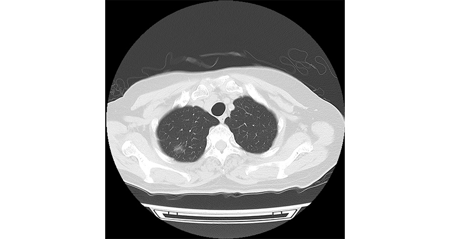 PCCTで撮影した胸部画像
