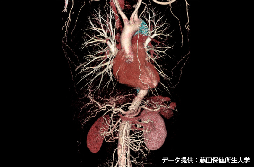 「Aquilion ONE」で作成された三次元画像（肺野、心臓、肝臓の末梢血管）の画像