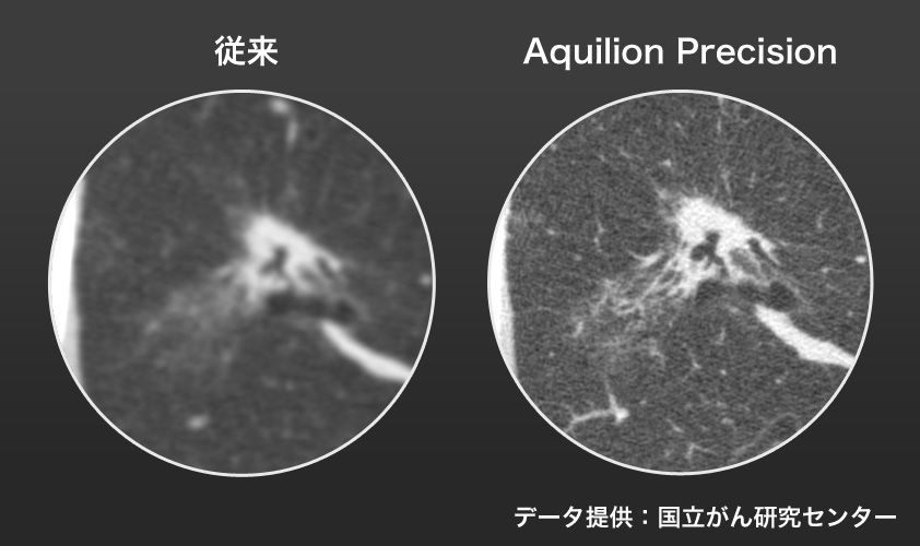 臨床画像（肺腺がん）の比較の画像
