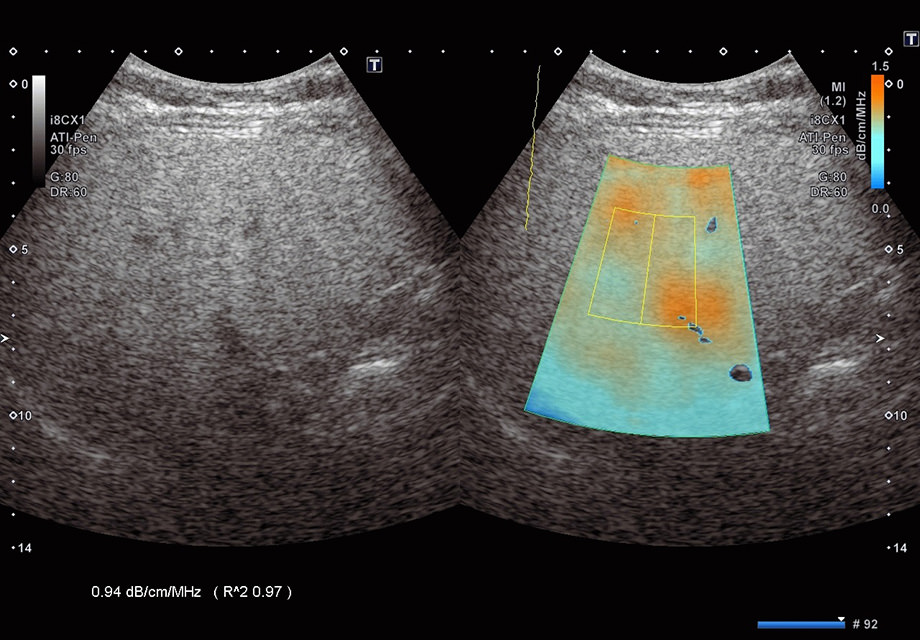 ATIによる脂肪肝診断の画像（指定された領域の超音波パルスが減少していく現象をカラーで表示。減っていく量を測定することで、数値化を実現）