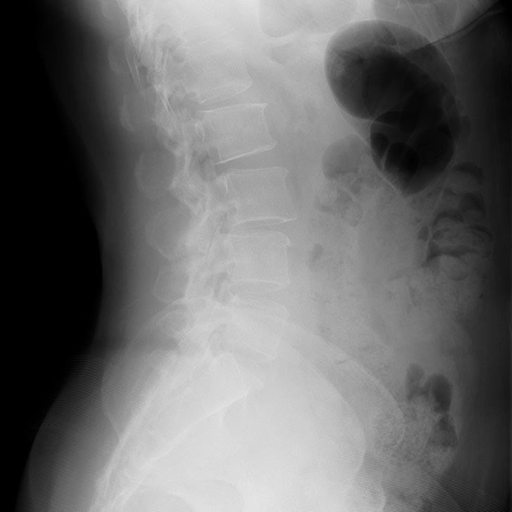 一般的なレントゲン撮影での腰椎側面画像
